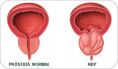 prostata1